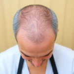 Best Hair Transplant Clinics In Encino, California