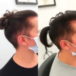 Best Hair Transplant Clinics In Latham, Nueva York