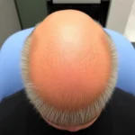 Best Hair Transplant Clinics In Marlton, New Jersey