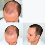 Best Hair Transplant Clinics In Middletown Township, New Jersey