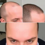 Best Hair Transplant Clinics In Olympia Fields, IL