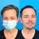 Best Hair Transplant Clinics In Princeton, New Jersey