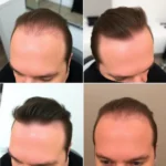 Best Hair Transplant Clinics In Stockbridge, Georgia