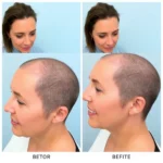 Best Hair Transplant Clinics In Tracy, California