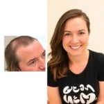 Best Hair Transplant Clinics In Walnut Creek, California