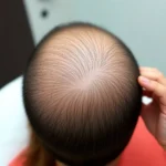 Best Hair Transplant Clinics In Williston, Vermont